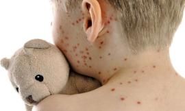 Morbillo: casi raddoppiati nel giro di un anno