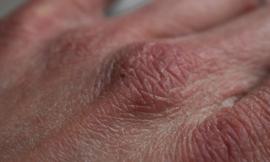Pelle secca? Ecco come combatterla con alcuni rimedi fai da te