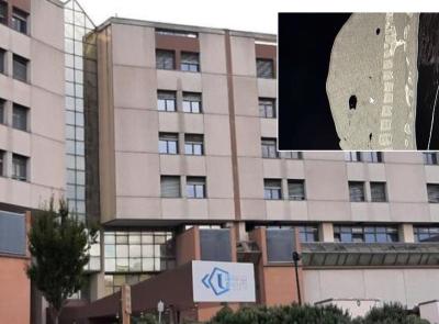 Ancona, intervento straordinario al midollo spinale su una bimba di 4 anni: "Ora sta bene, cammina e non cade più"