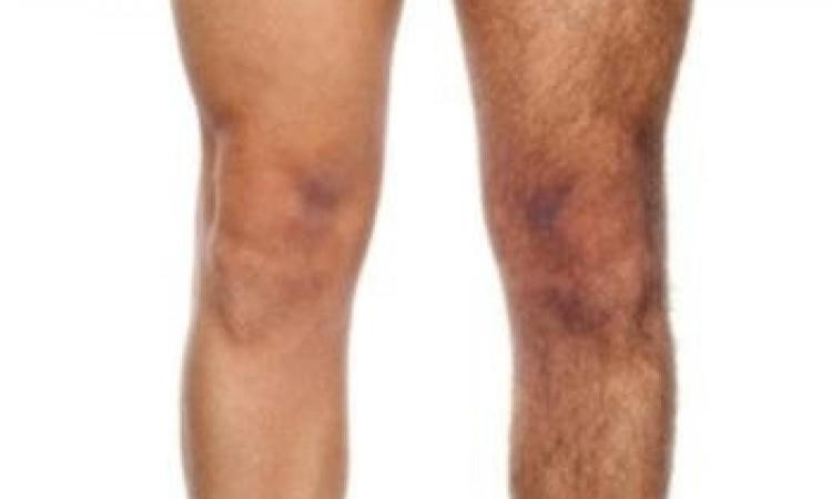 Cosa fare per la pelle strappata dopo ceretta