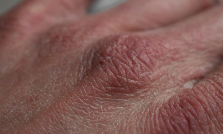 Pelle secca? Ecco come combatterla con alcuni rimedi fai da te