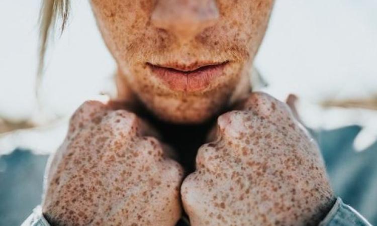 Bellezza: cosa sapere sulle macchie pigmentarie e come attenuarle