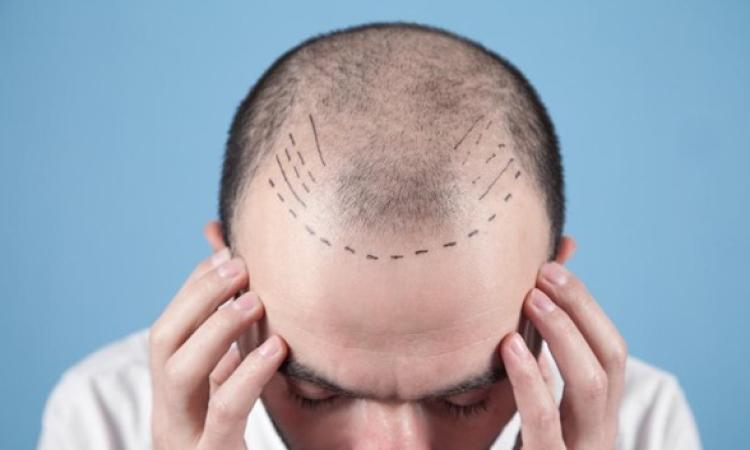 Guida sui Trapianti di Capelli con Tecnica FUE in Turchia Guida sui Trapianti di Capelli con Tecnica FUE in Turchia