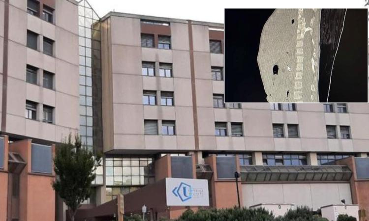 Ancona, intervento straordinario al midollo spinale su una bimba di 4 anni: "Ora sta bene, cammina e non cade più"